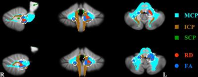 Alterations of cerebellar white matter integrity and associations with cognitive impairments in schizophrenia